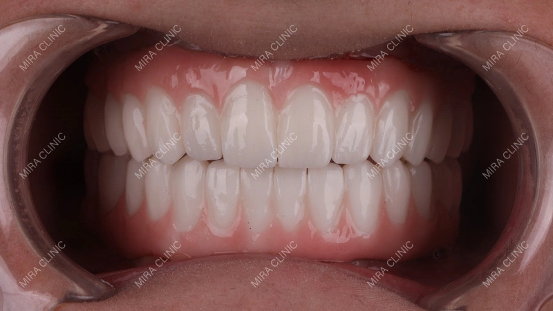 Zirconium Crowns in Turkey